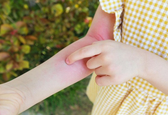 A child in a yellow gingham dress pointing to a red rash on their arm, possibly indicating a skin allergy or irritation, amid a backdrop of lush greenery, potentially related to a hornet sting threat.